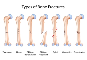 fracture
