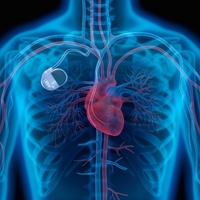 pacemaker
